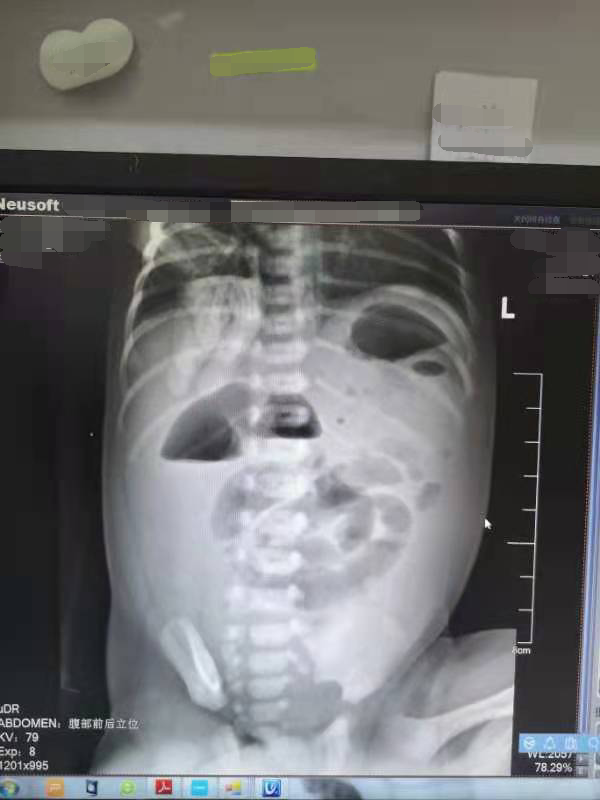 初生三天宝宝反复呕吐，竟然要切掉35cm肠子？！