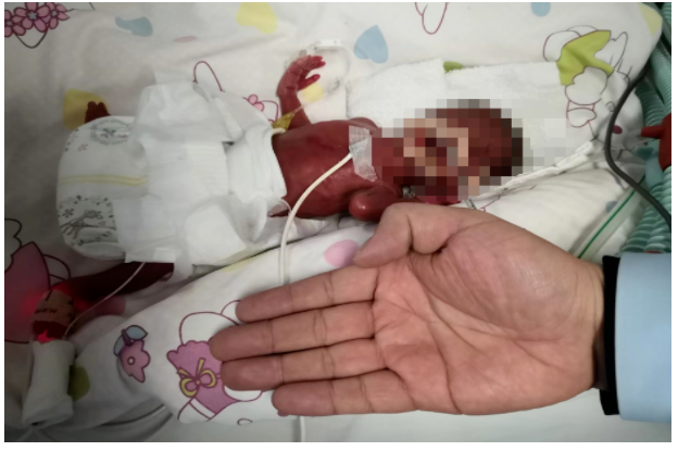 【再刷记录】出生仅1斤,126天勇闯难关：桂林体重最轻、孕周最小的超早产儿回家啦
