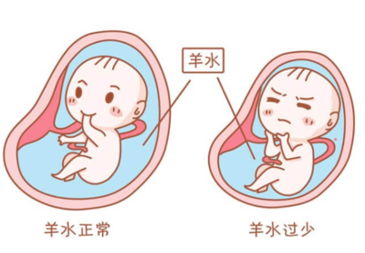 重塑宫内“海景房”，桂林妇幼实施羊膜腔灌注助力羊水过少孕妈顺利分娩